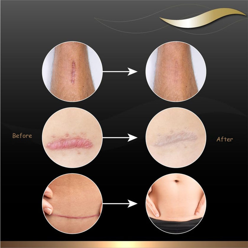 Dermatix Silicone Gel 15g