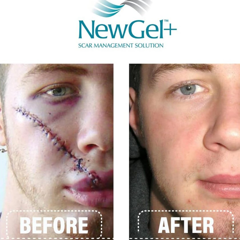 NewGel+E Advanced Medical-Grade Silicone Gel + Vitamin E for All Scar Types 15g