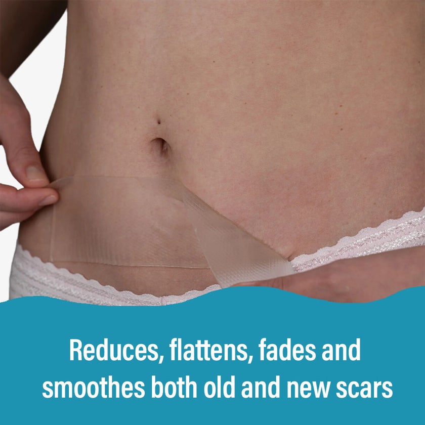 NewGel+ Advanced Medical-Grade 2" x 8" C-Section Strip For C-Section Scar Management, NG-360 Clear