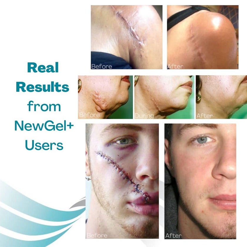 NewGel+ 24" x 2" Abdomen/Extremity Silicone Strip, Clear - NG-364