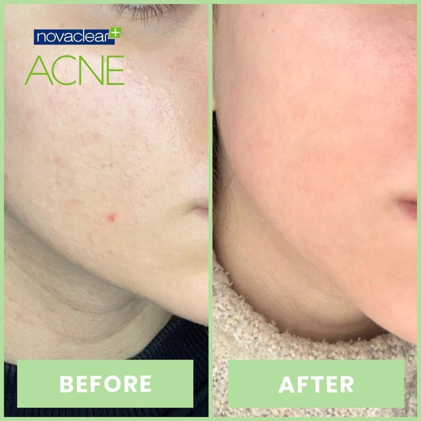 Novaclear Acne Kit With Acne Facial Foam 100ml + Acne Toner 150ml + Acne Cream For Oily, Combination & Acne-Prone Skin 40ml