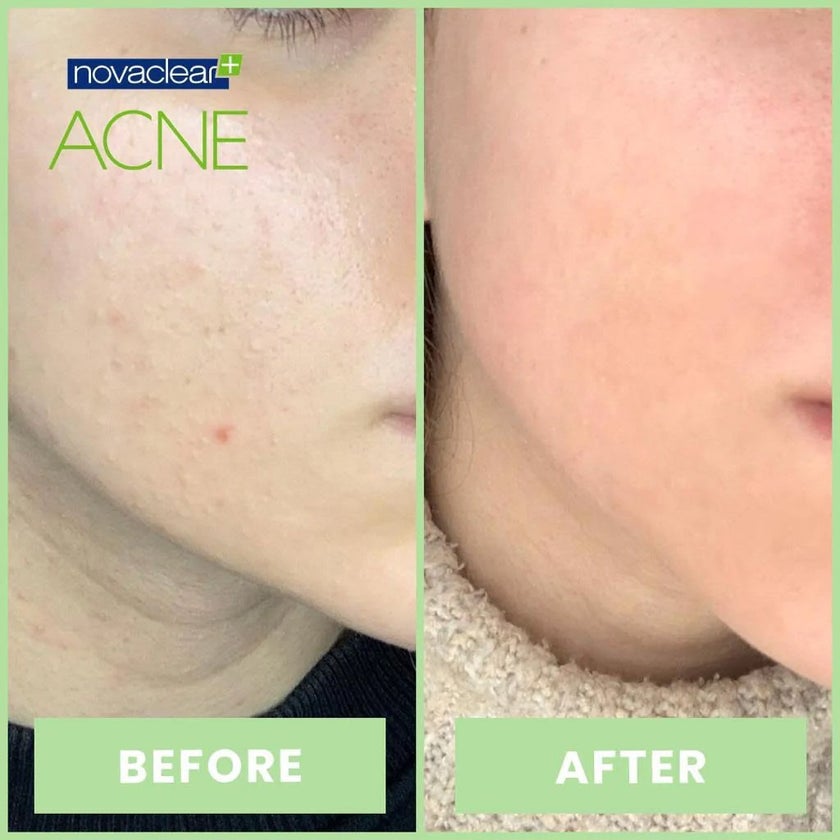 Novaclear Acne Cream With Salicylic Acid For Oily And Acne Prone Skin 40ml