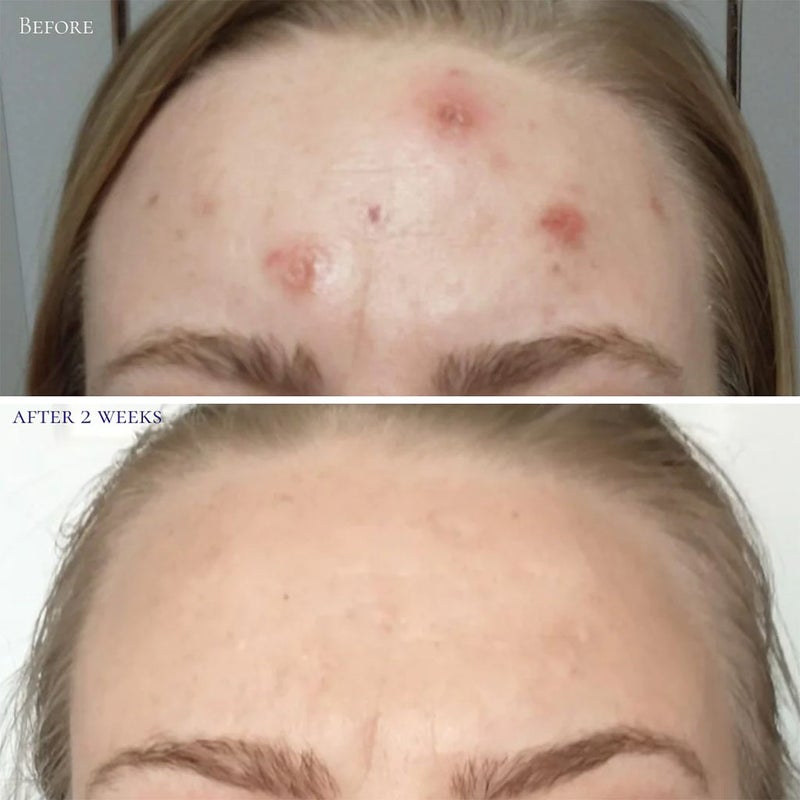 GlowBiotics Probiotic Clarifying Professional Peel For Acne With AHA & BHA 60ml