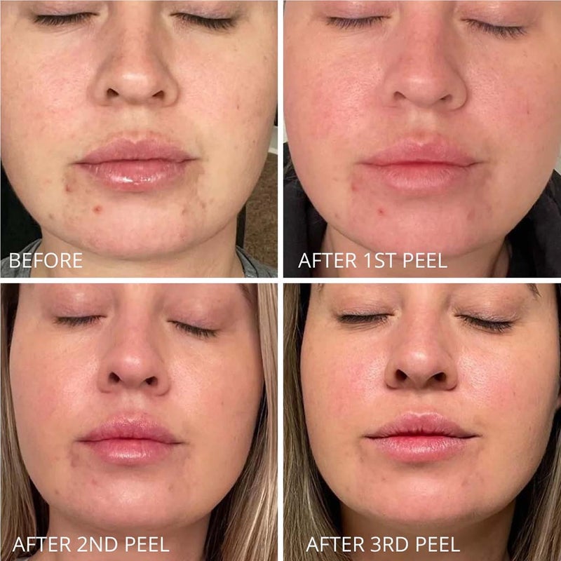 GlowBiotics Probiotic Clarifying Professional Peel For Acne With AHA & BHA 60ml