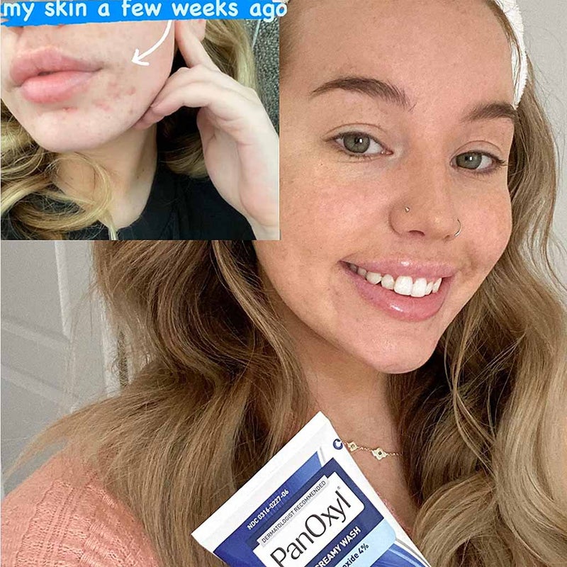 PanOxyl Acne Creamy Face & Body Wash With 4% Benzoyl Peroxide 170g
