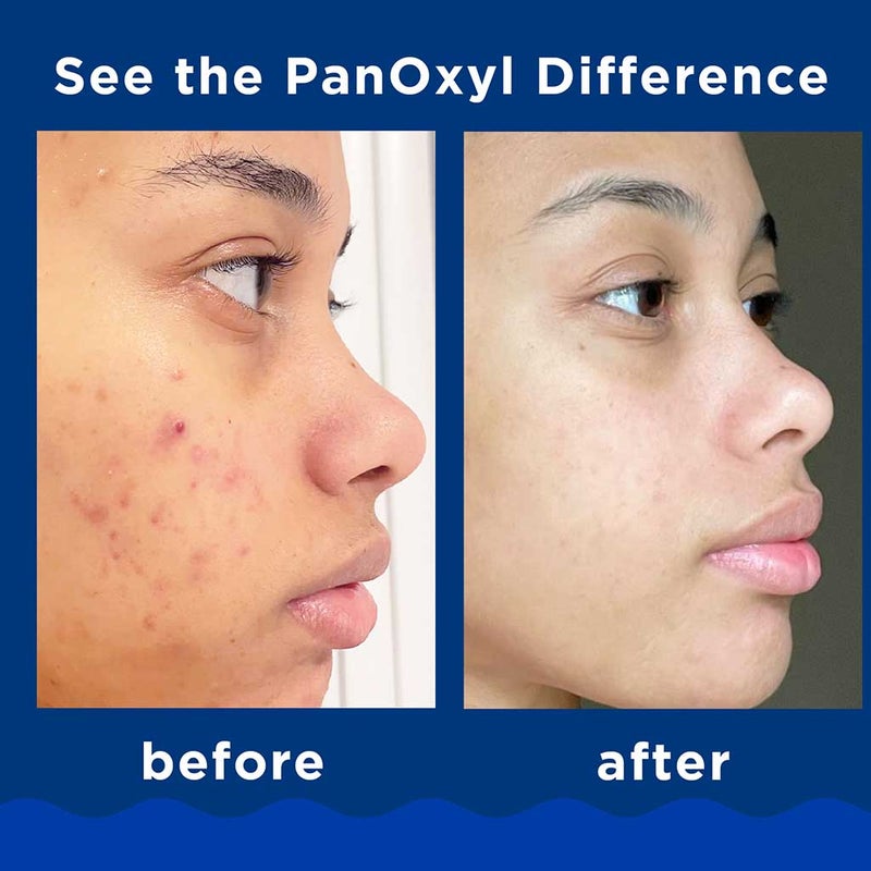PanOxyl Acne Foaming Face & Body Wash With 10% Benzoyl Peroxide 156g 