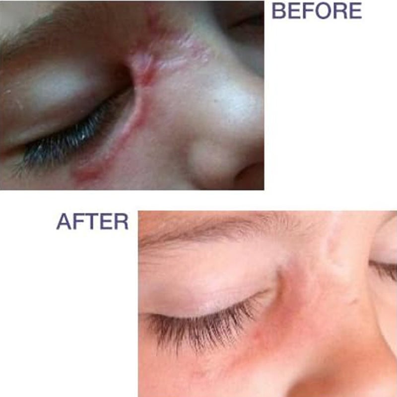 Biodermis Prosil SPF15 Silicone Stick For Scars 4.25g