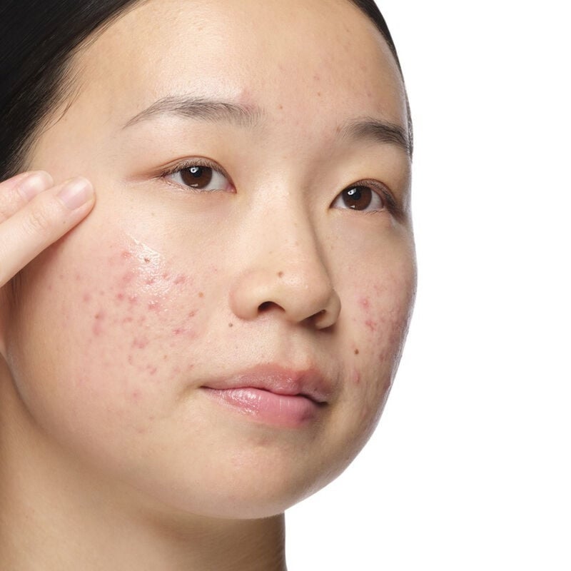 The Ordinary Aloe 2% + NAG 2% Solution For Post Acne Marks 30ml 