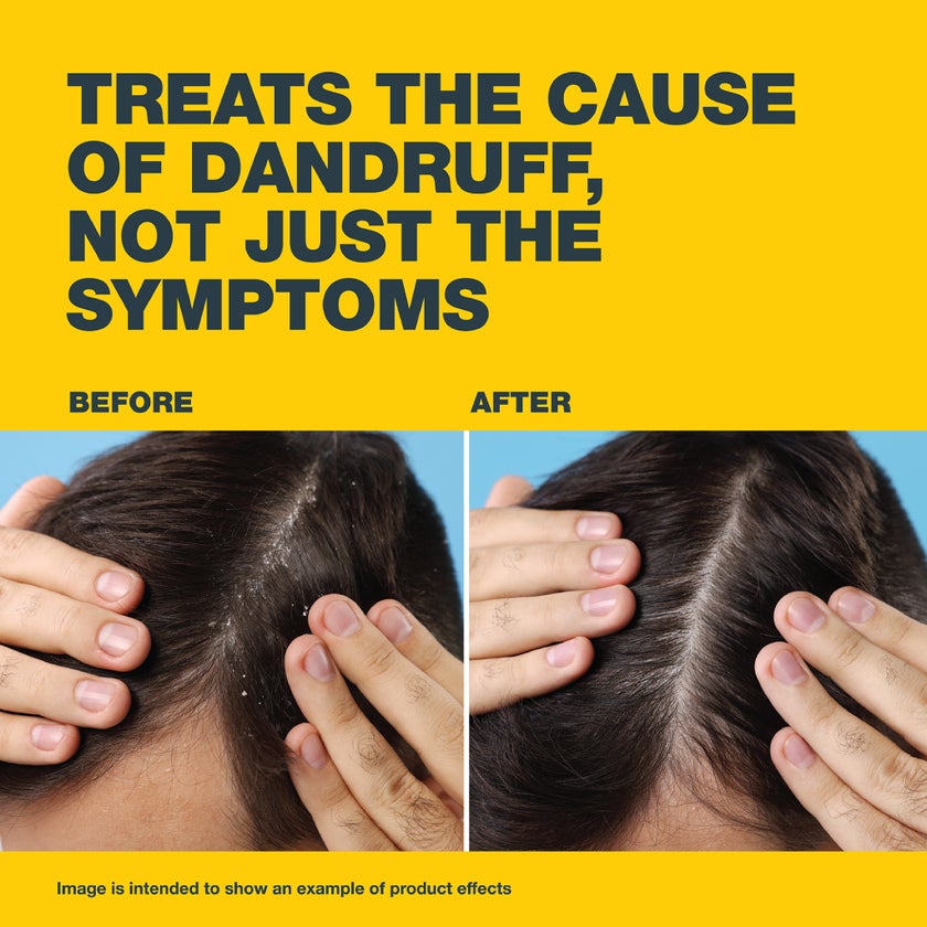 Nizoral 2% Anti Dandruff Shampoo 100ml